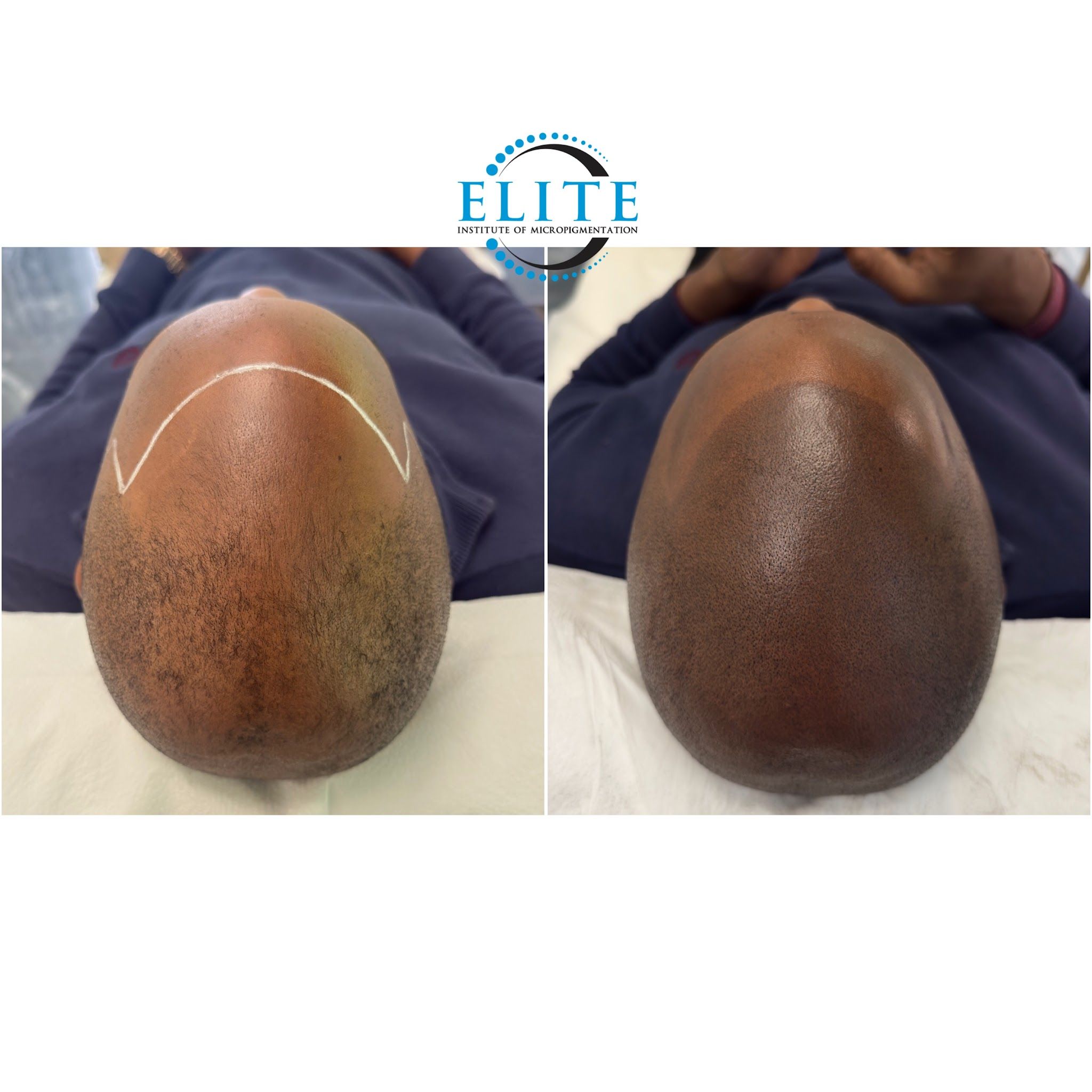 Scalp Micropigmentation result by Elite Institute of Micropigmentation Atlanta in Atlanta, GA