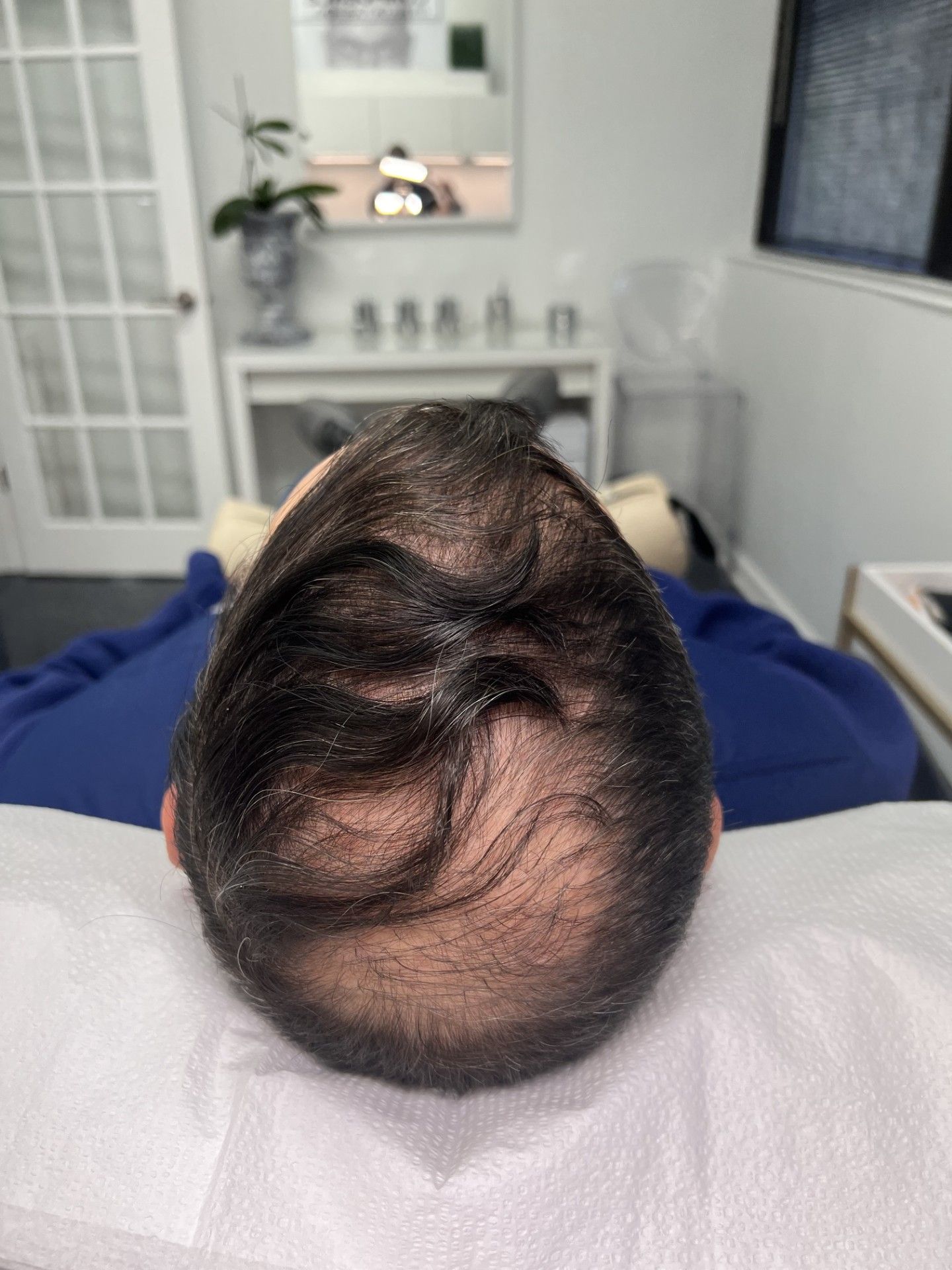 Scalp Micropigmentation result by Elite Institute of Micropigmentation Atlanta in Atlanta, GA