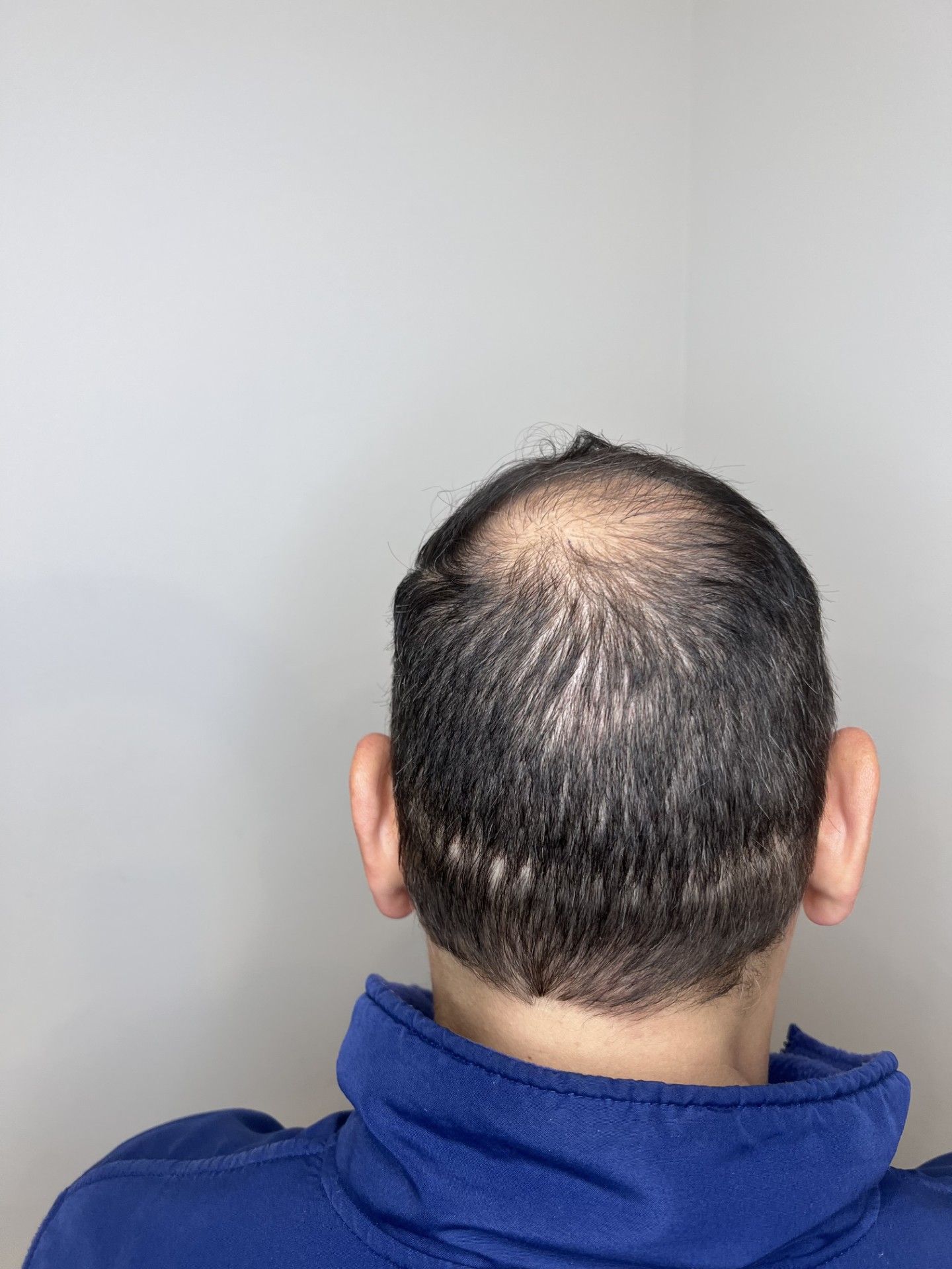 Scalp Micropigmentation result by Elite Institute of Micropigmentation Atlanta in Atlanta, GA